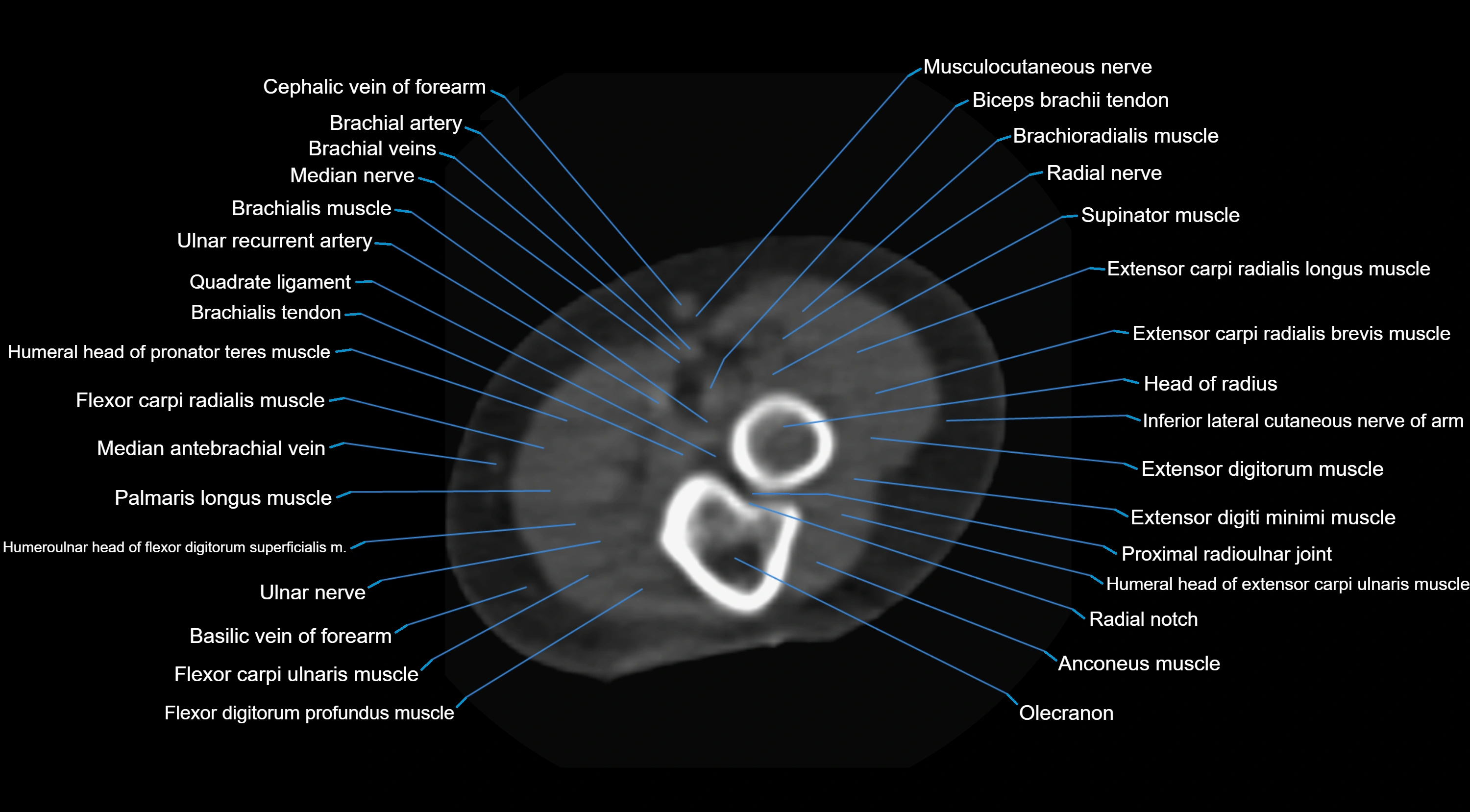 CT elbow axial  cross sectional anatomy labelled  radiology image -00034.webp